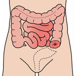 Colostomie: Dickdarmausgang endst&auml;ndig oder doppell&auml;ufig  