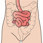 Ileostomie:  D&uuml;nndarmausgang endst&auml;ndig oder doppell&auml;ufig